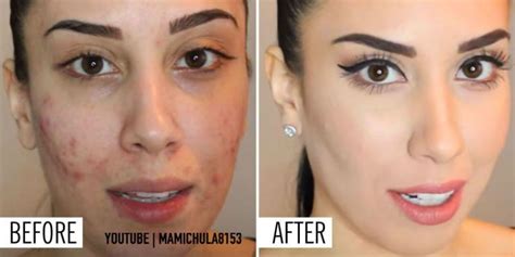 foundation that helps clear acne.